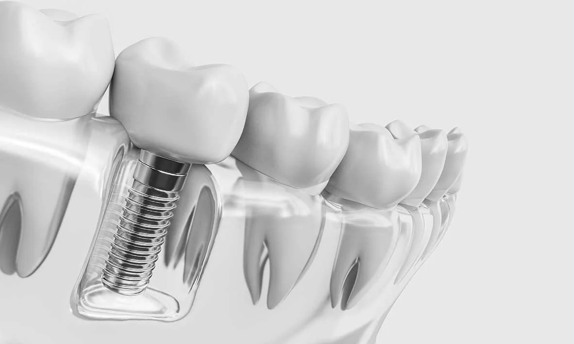 Dental implants and specialist implant care