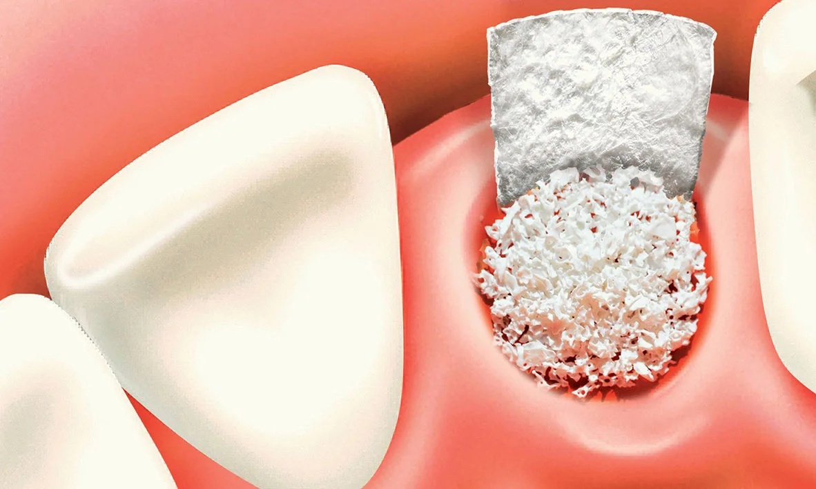 Bone grafting for dental implants